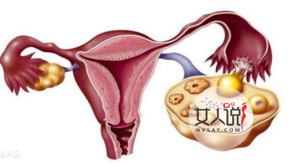 卵巢囊肿症状有哪些，这些表现不能够忽视